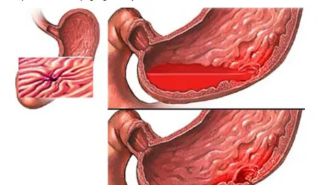 PPI Liều Cao Sau Nội Soi Cầm Máu Loét Dạ Dày: Truyền Bao Lâu, Khi Nào Được Dừng Sớm?